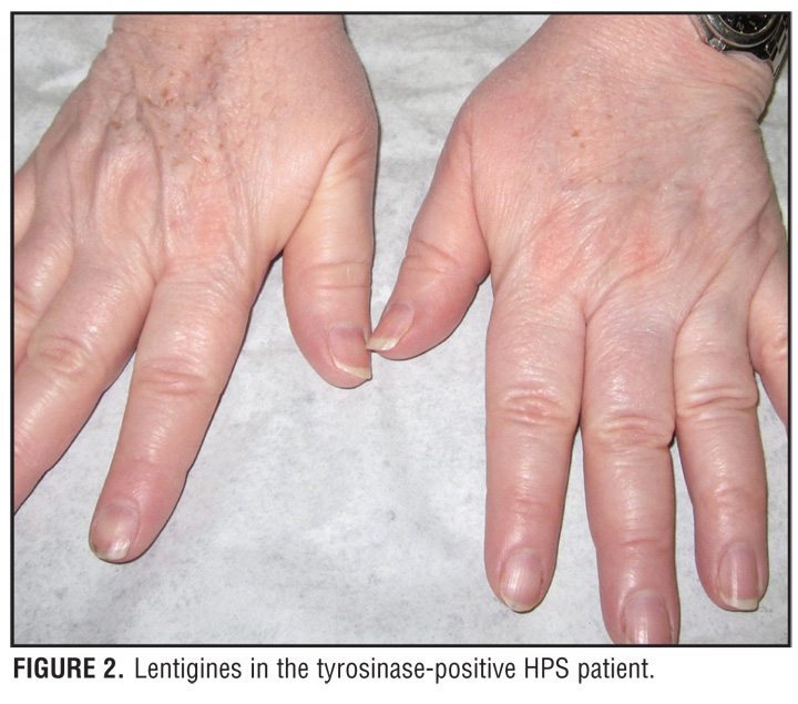 картинки hermansky-pudlak syndrome 2 - A Case of Hermansky-Pudlak Syndrome 