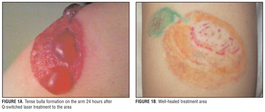 Treatment of Large Bulla Formation after Tattoo Removal with a Q ...