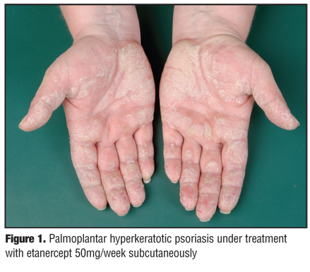 Psoriasis Fingertips