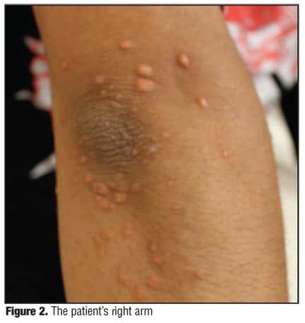 Cholesterol+deposits+under+eyes