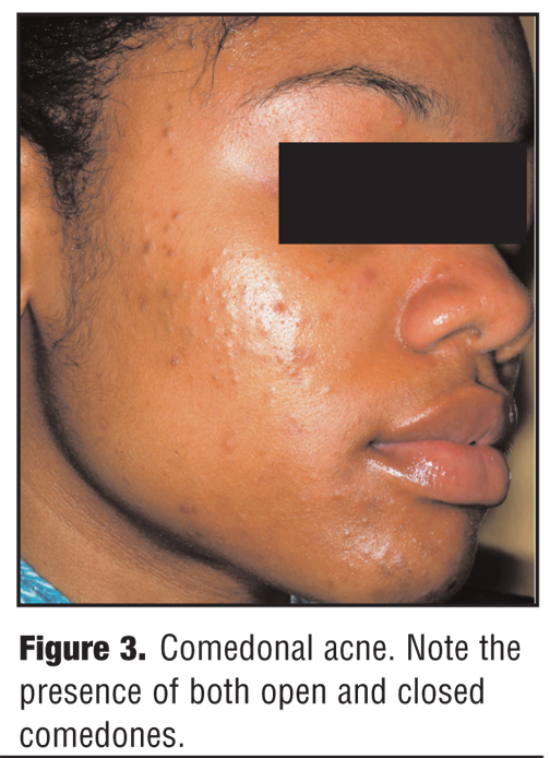 African American Herpes