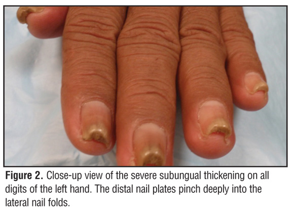 Acquired Pincer Nail Deformity Associated with Renal Failure 