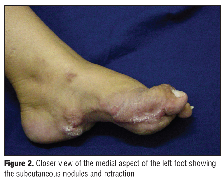 What is a good treatment for plantar fibroma?